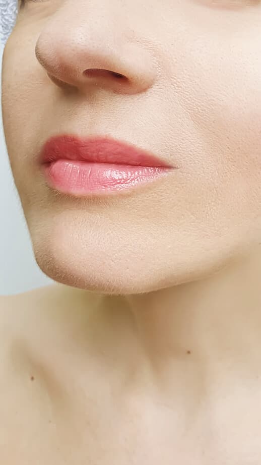 Lip and chin filler results
