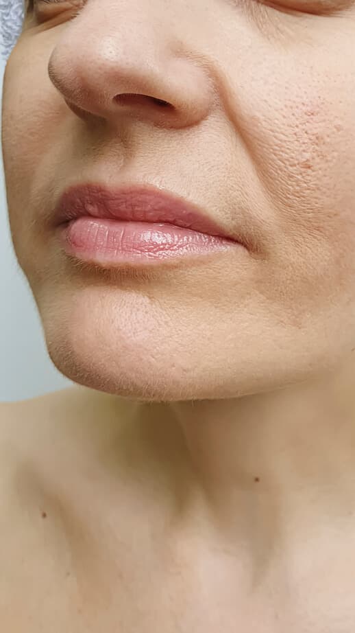 Lip and chin filler results