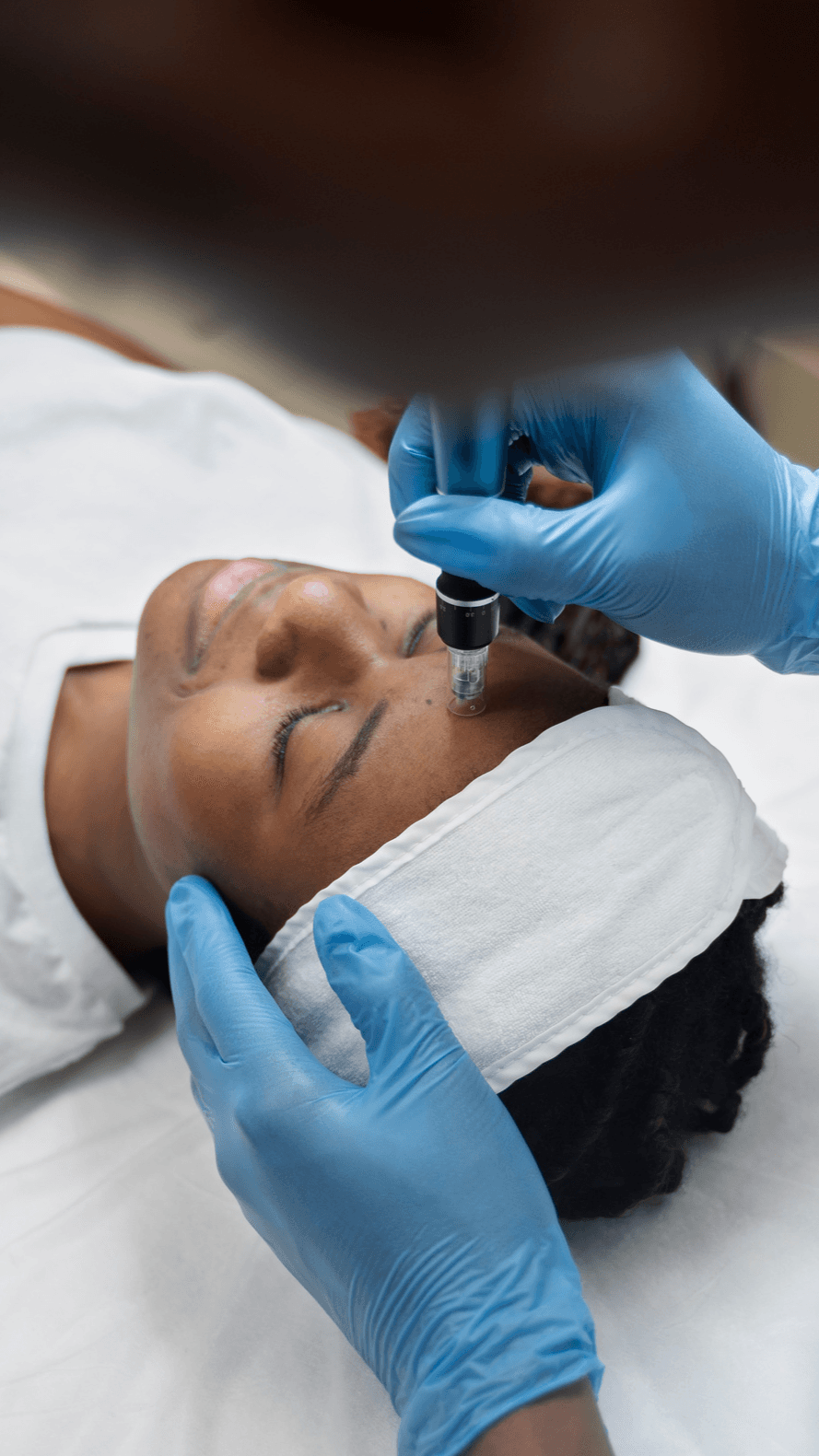 Microneedling
